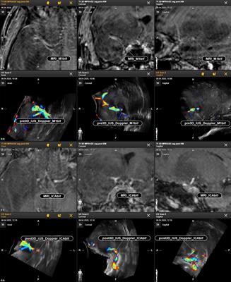 Utilizing Intraoperative Navigated 3D Color Doppler Ultrasound in <mark class="highlighted">Glioma Surgery</mark>